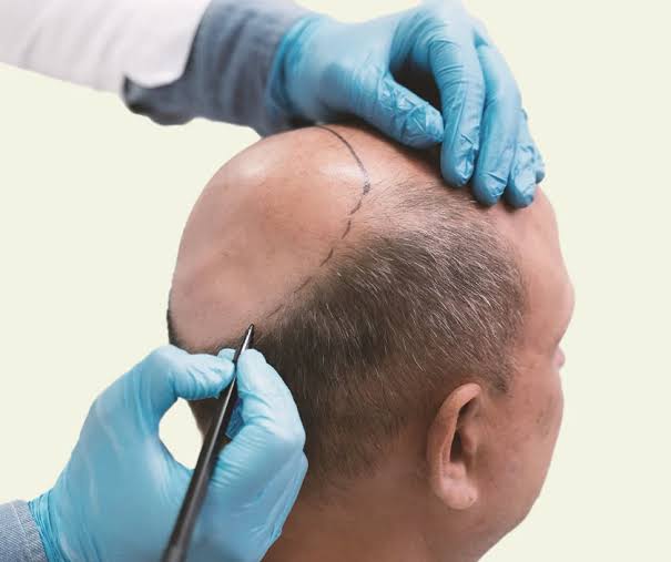  Discover a Smarter Path to Hair Restoration