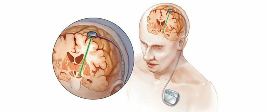  Best Hospitals in India for Deep Brain Stimulation for Ethiopian patients