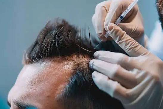  Advanced FUE Hair Transplant in Chandigarh for Fuller-Looking Hair