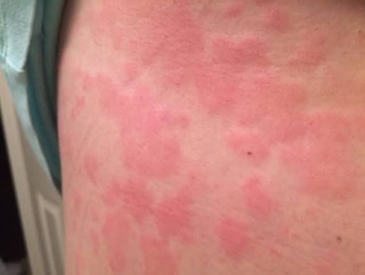  Mast Cell Activation Syndrome