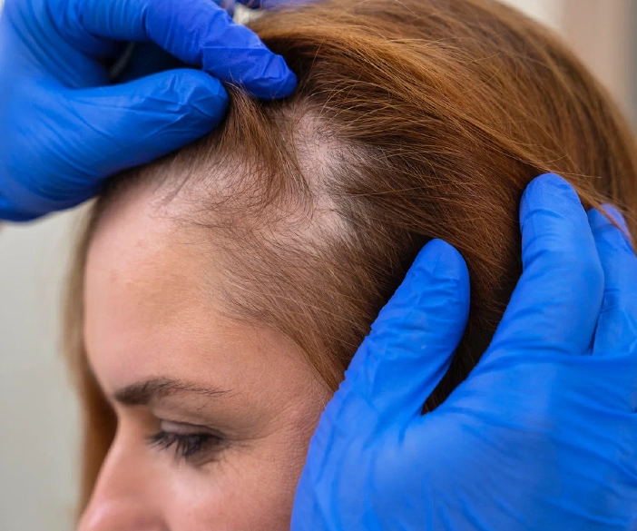  Advanced Hair Loss Treatment with IV Therapy, Chennai