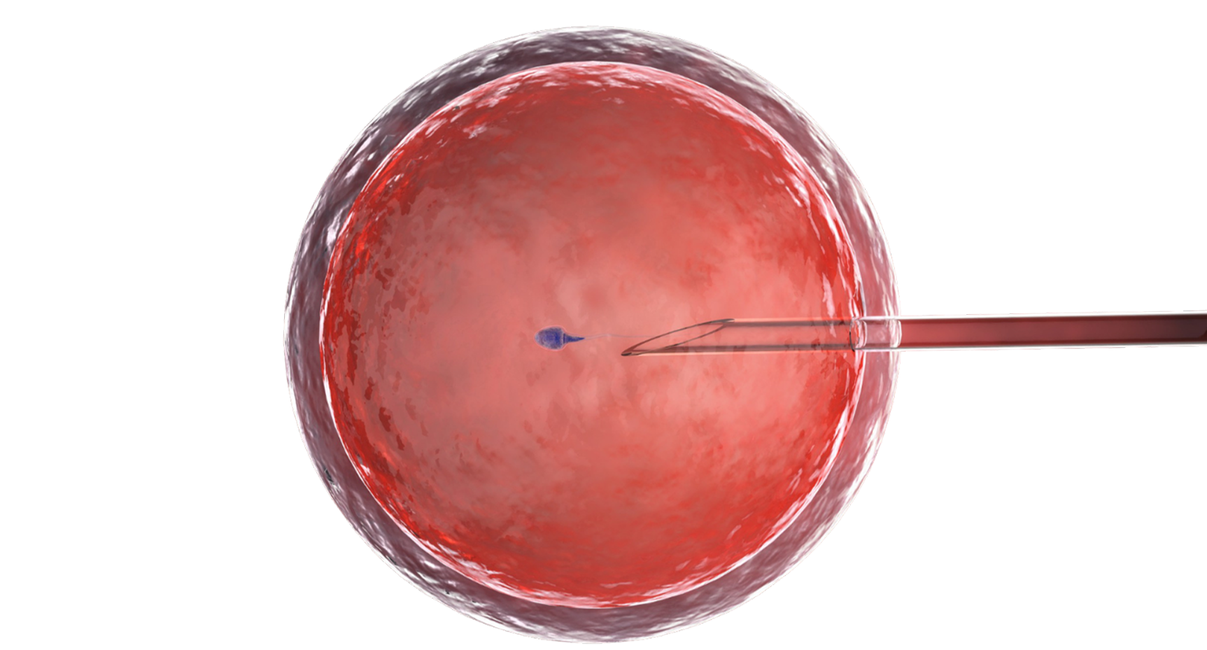  Choose the Right ICSI Treatment Centre in Delhi | Queens IVF