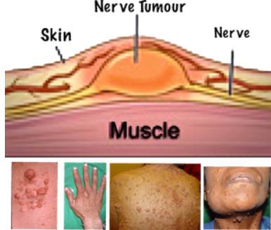  What Is NF?: Understanding Neurofibromatosis