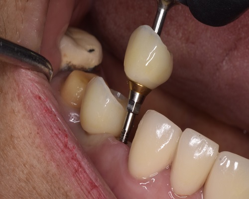  Trusted Dental Clinic in Tijuana – Comprehensive Care for a Brighter, Healthier Smile