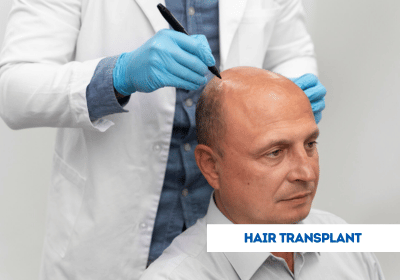  Hair Transplant - Causes, Symptoms Treatment Cost | India
