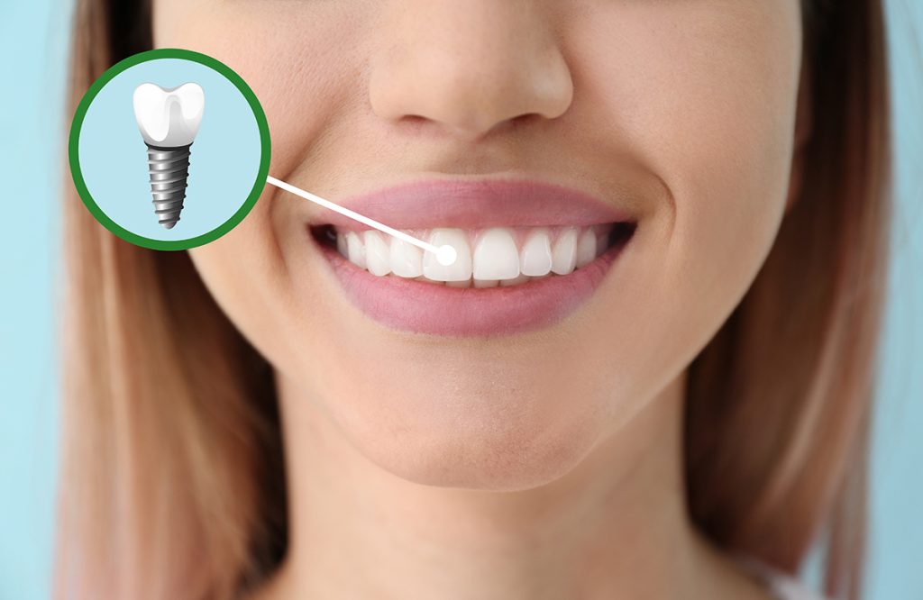  Dental Implants Bromley for a Confident, Natural-Looking Smile
