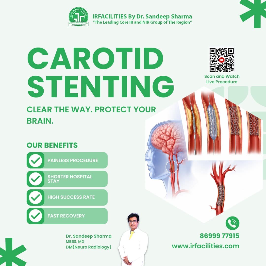  Carotid Stenting Procedure – Carotid Stenting Technique