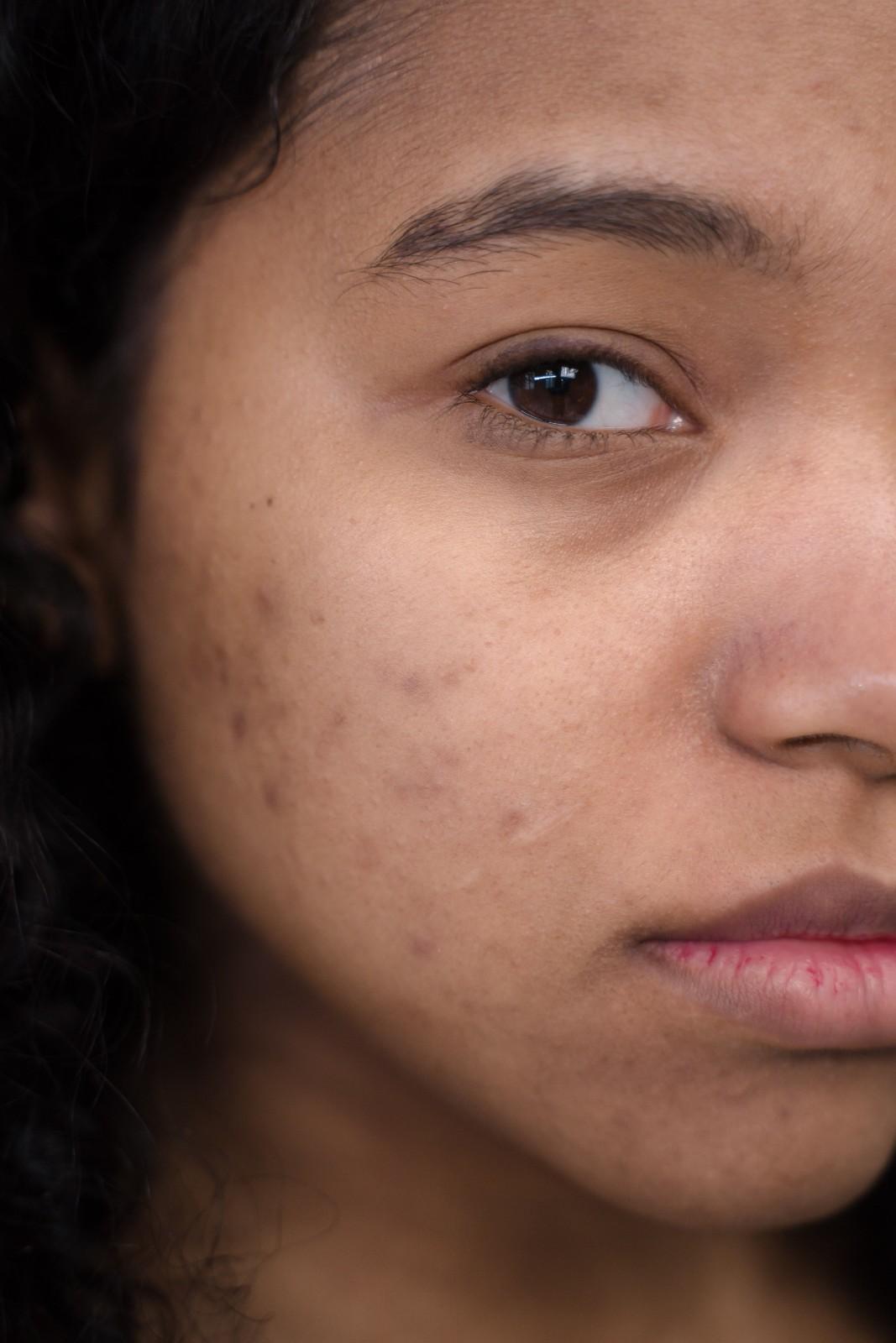 Acne Treatment in Roorkee
