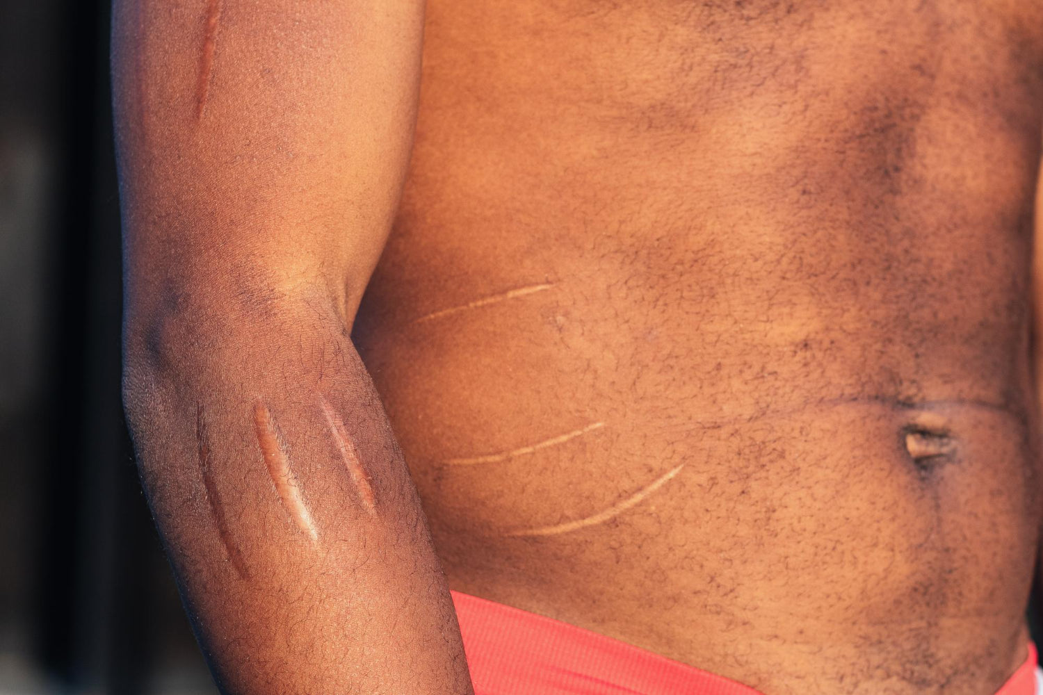  Surgical scar revision in Dubai