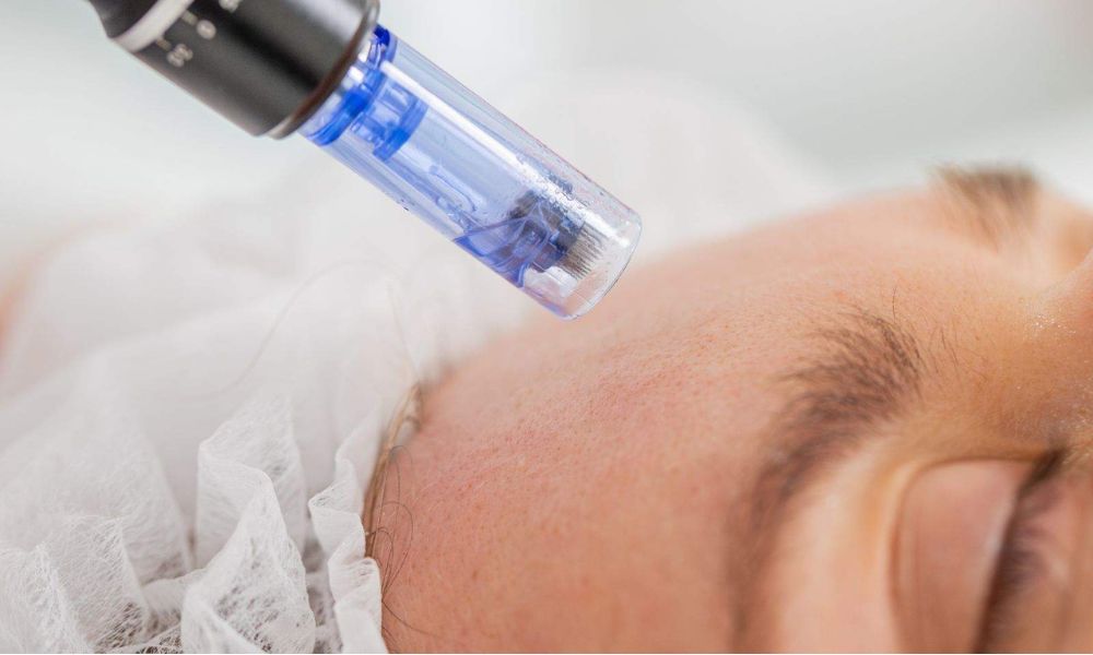  Professional Microneedling in Reading | A.D. Beauty Clinic