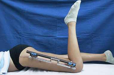  Trusted Limb Lengthening Surgeon in Delhi