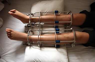  Height Increase Surgeon in Delhi – Experienced Limb Lengthening Specialist