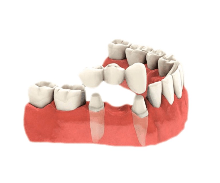  Pròtesi Dental Gines | Clinicadentalcristinamora.com