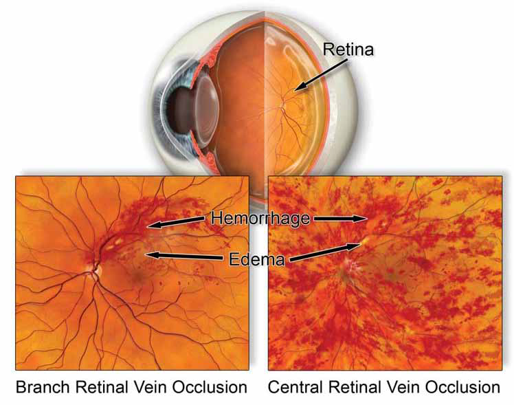  Reliable Care for Retinal Circulation Problems