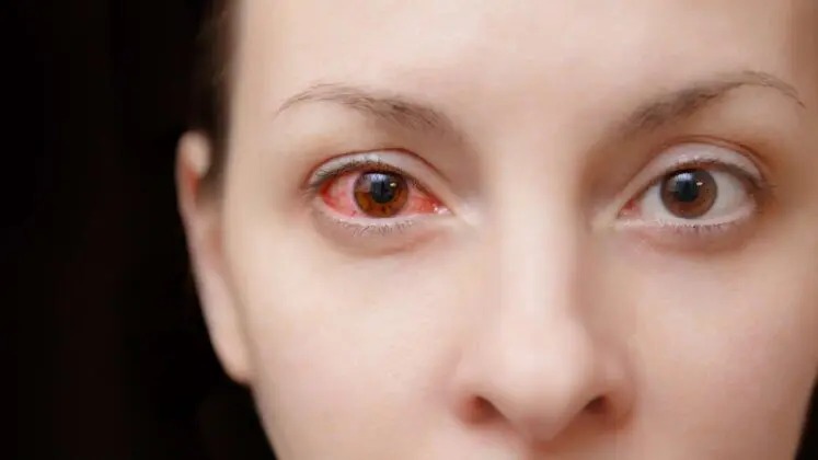  Eye Disease Treatment in Faridabad at Eyeroots