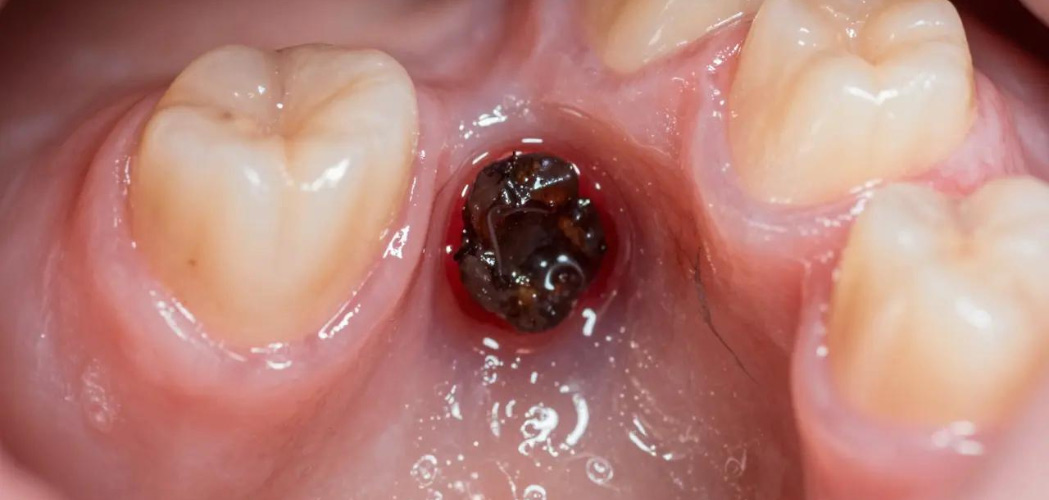  how to prevent dry socket