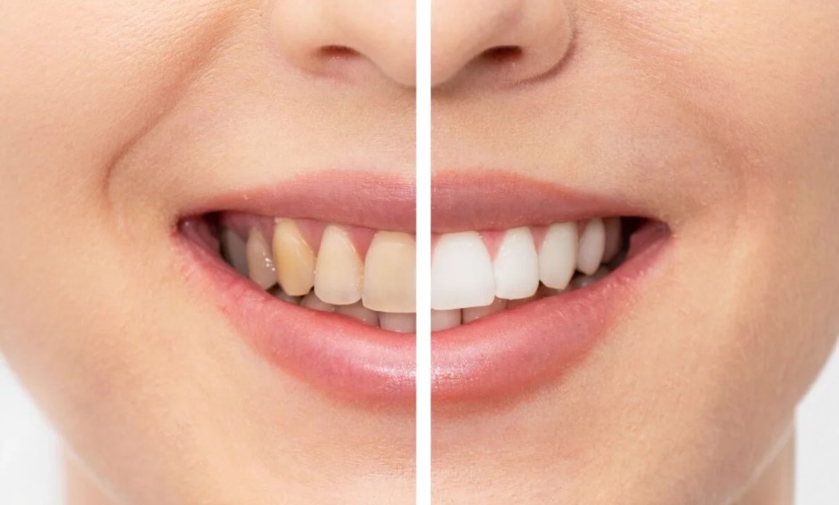  Professional Laser Teeth Whitening Clinics for a Radiant Smile