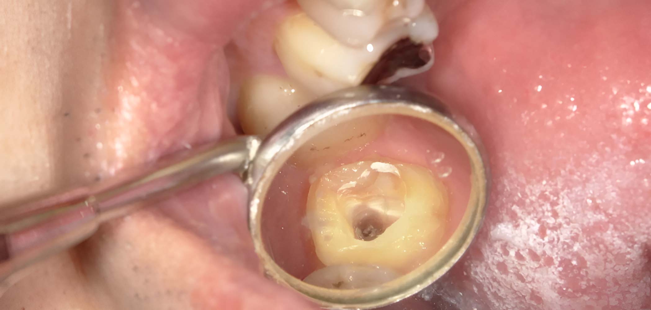  Cracked Tooth Root: Causes, Symptoms, Diagnosis & Treatment
