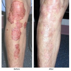  AROGYAM PURE HERBS KIT FOR PSORIASIS