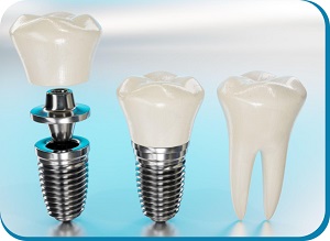  Best Dental Implant in Ahmedabad