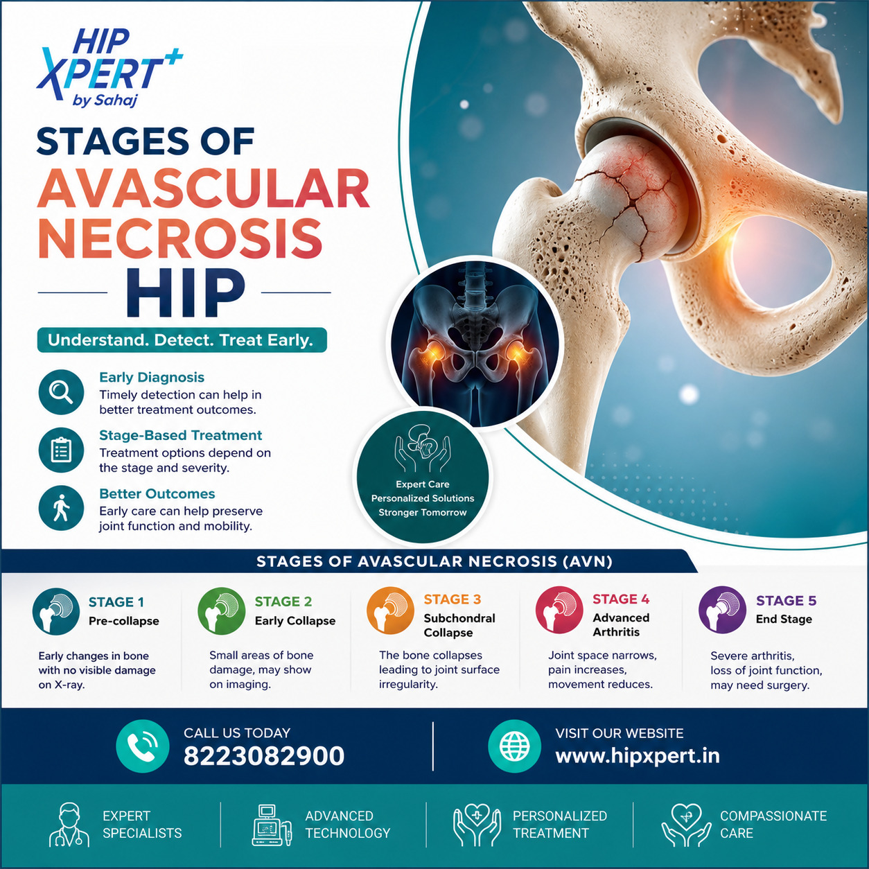  Stages of Avascular Necrosis Hip - HipXpert