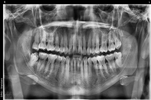  Gum Graft in Tijuana – Restore Your Smile with Expert Care