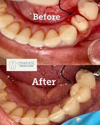  Need Root Canal Treatment in Mahanagar? What Should You Know?
