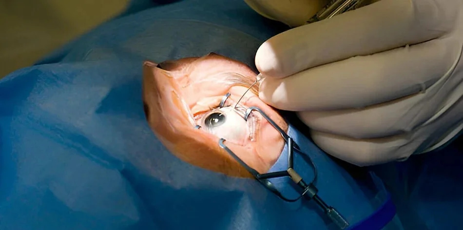  Cataract Surgery in Faridabad for Clearer Vision