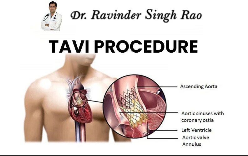  Jaipur TAVI Expert for Transcatheter Heart Valve Procedures – Dr. Ravinder Singh Rao