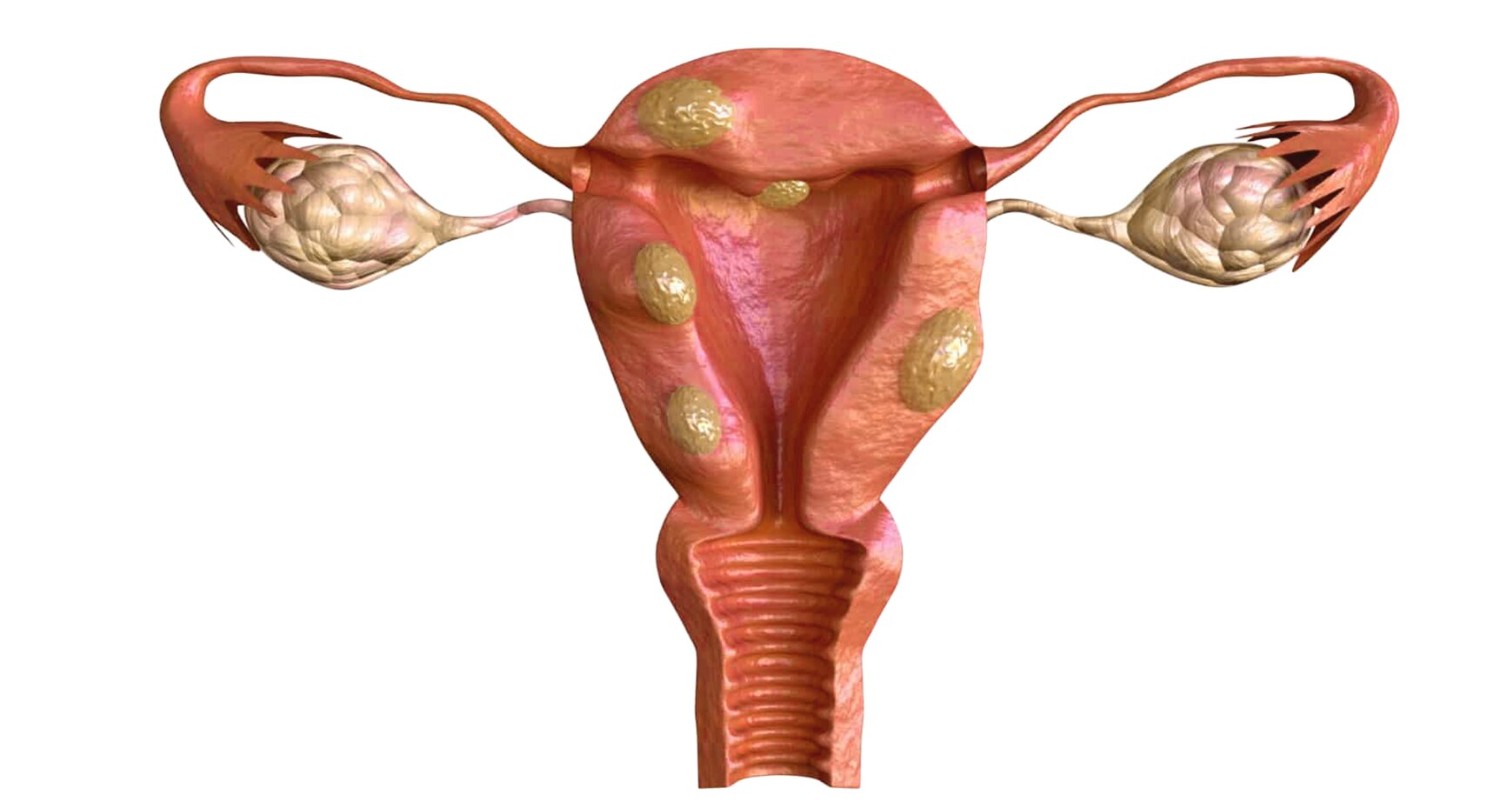  Get Expert PCOS Treatment in Delhi at Queens IVF