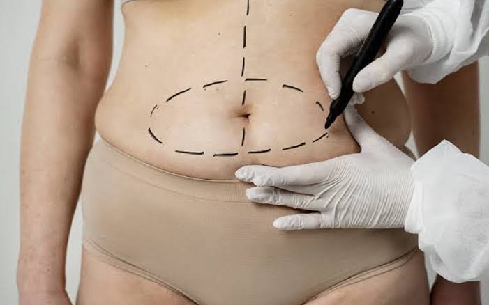  Liposuction Before and After: How Results Mature With Healing