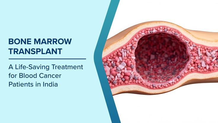  Bone Marrow Cancer Treatment Doctors