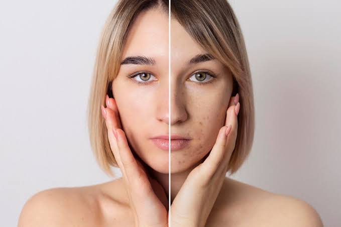  Can Modern Acne Treatment Minimize Pimples and Acne Marks?