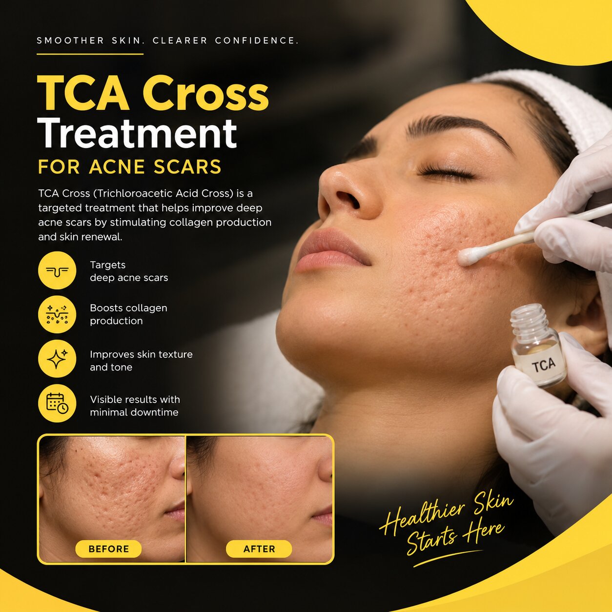  Get Expert Guidance on TCA CROSS Treatment for Acne Scars at MedLinks