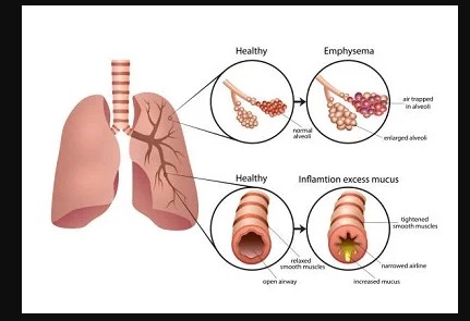  Expert Endobronchial Ultrasound for Lung Evaluation in Jaipur, Rajasthan | Asthma Bhawan