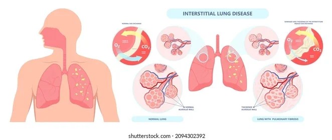  Expert Pulmonologist for Interstitial Lung Disease in Jaipur | Dr. Virendra Singh