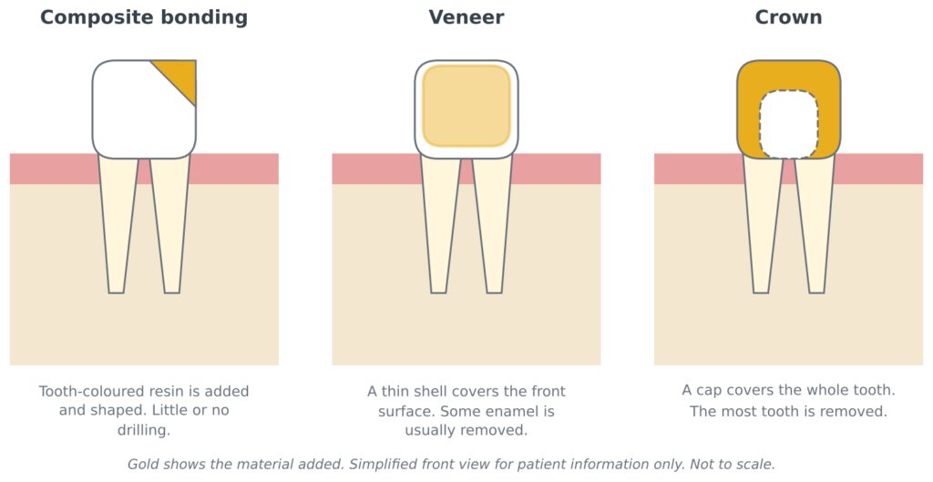  Compare Veneers, Crowns and Bonding for Your Smile in Bristol