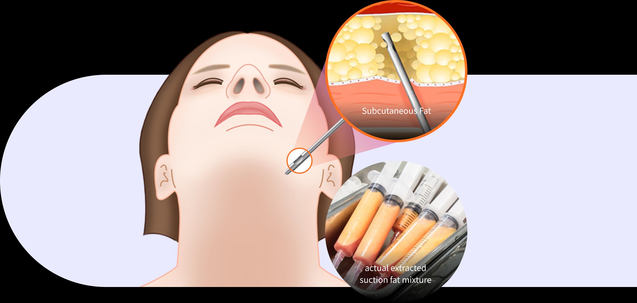  Double Chin Surgery in Korea at Mine Clinic