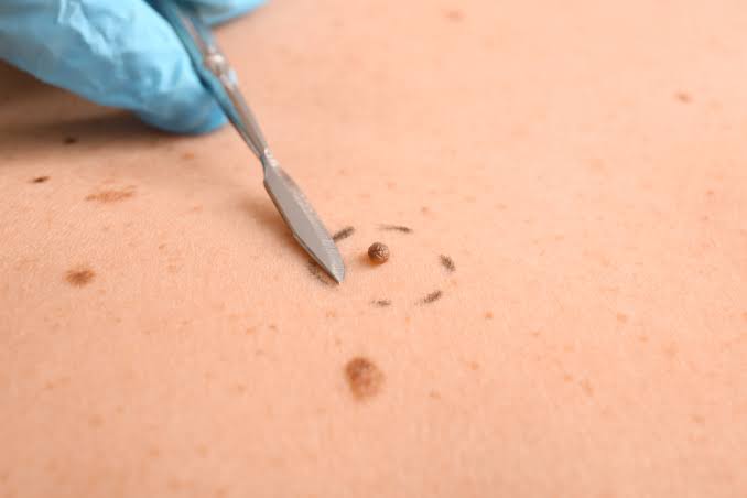  Can Mole Removal Help You Achieve Clearer-Looking Skin?