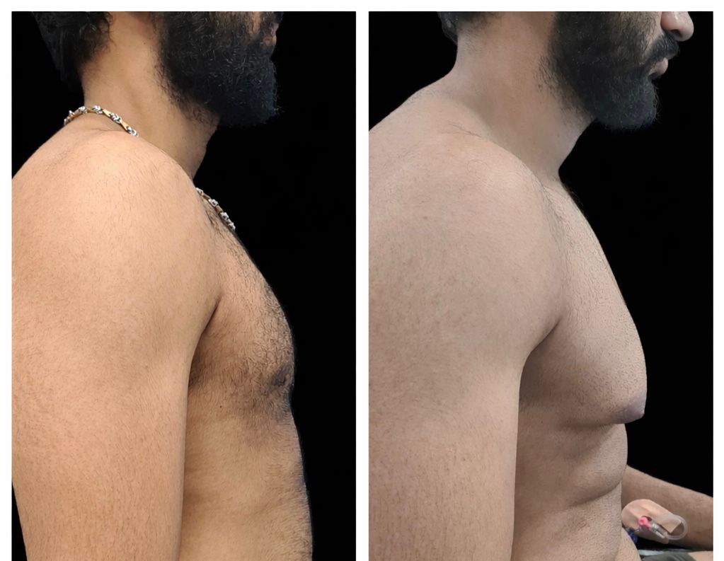  Gynecomastia Treatment in Baner - The Aesthetic Hub