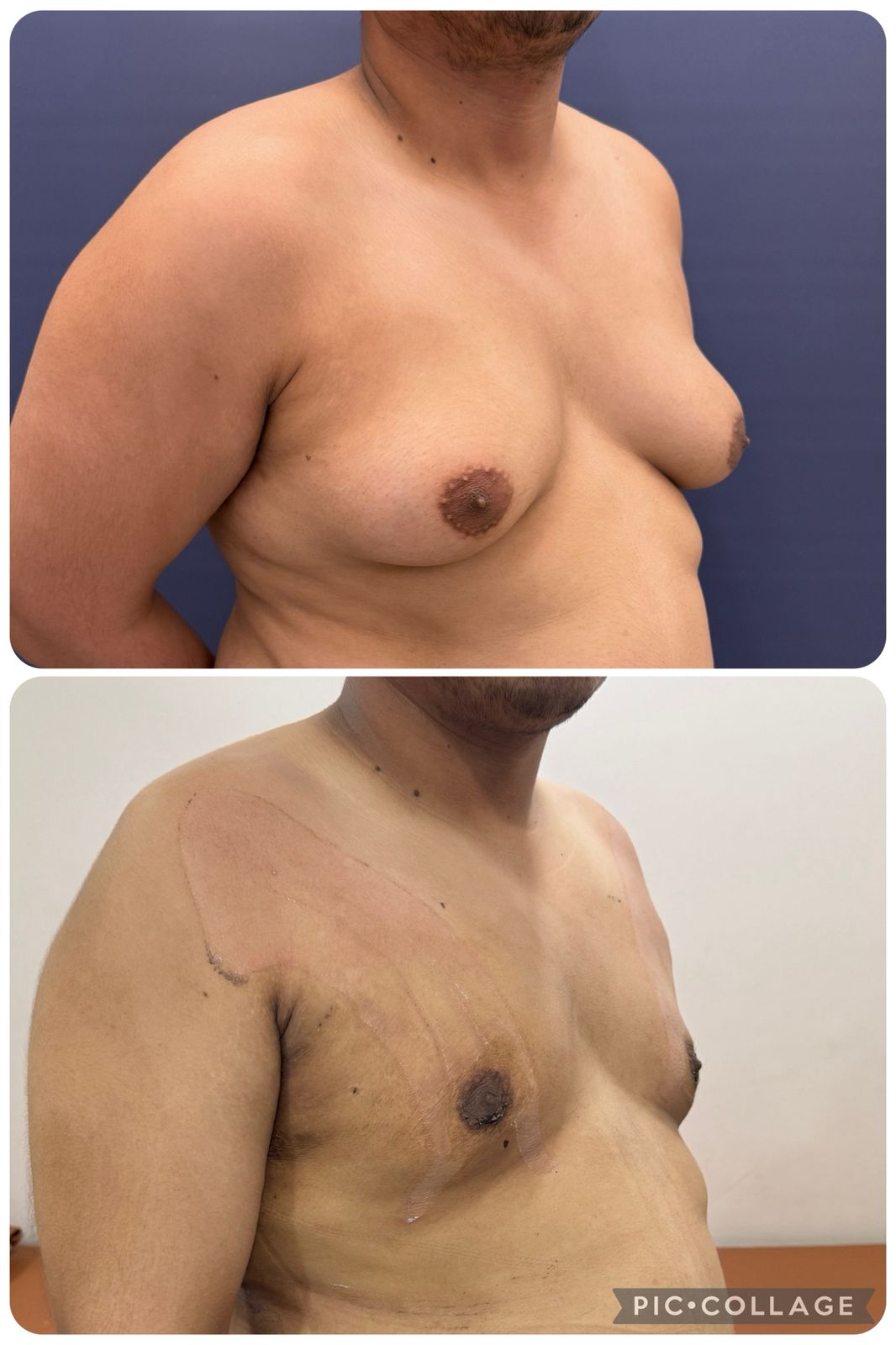  Gynecomastia surgery in Baner  - The Aesthetic Hub
