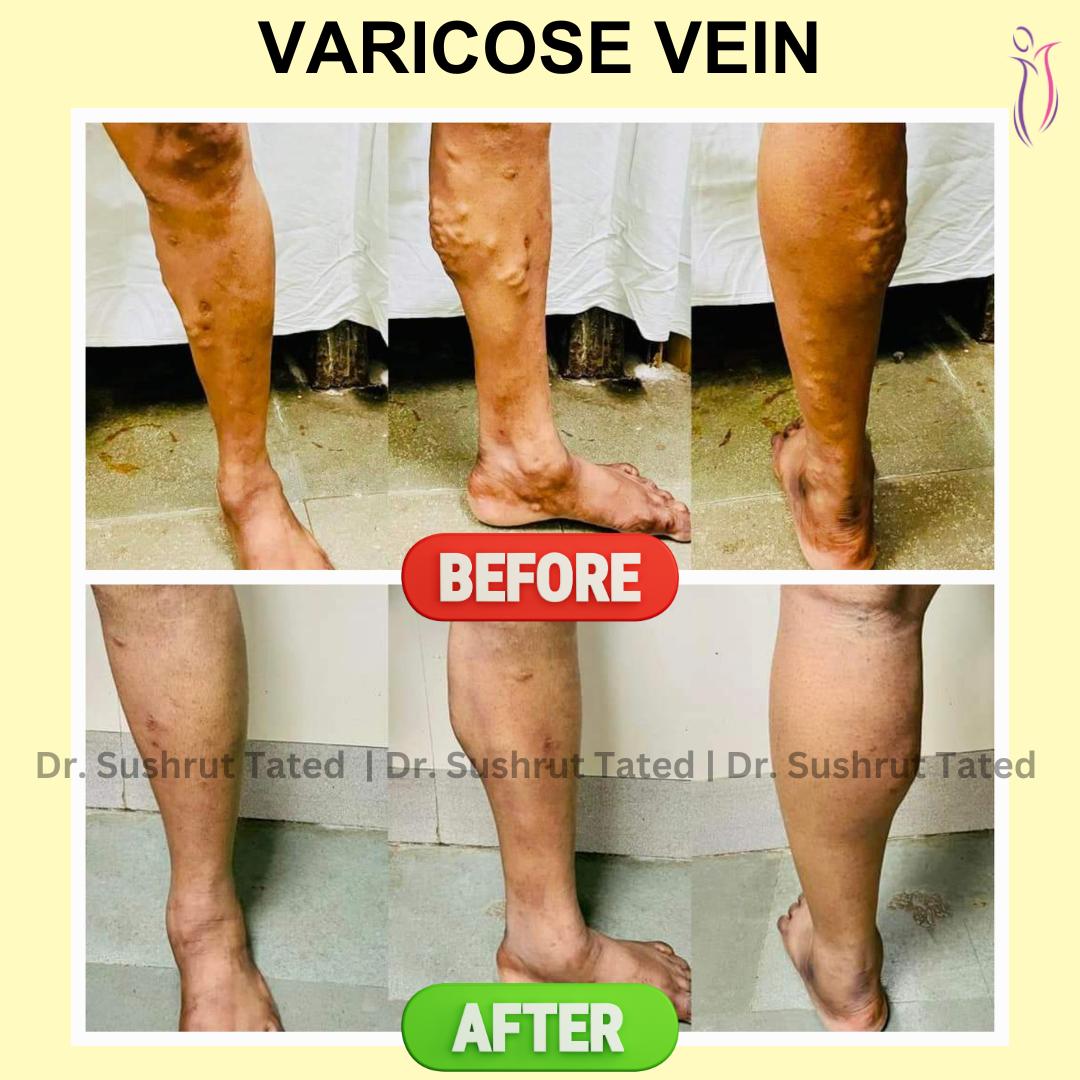  Varicose veins surgery in Baner - The Aesthetic Hub