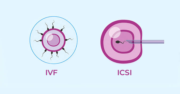  ICSI Treatment (Intracytoplasmic Sperm Injection) in Greater Noida West